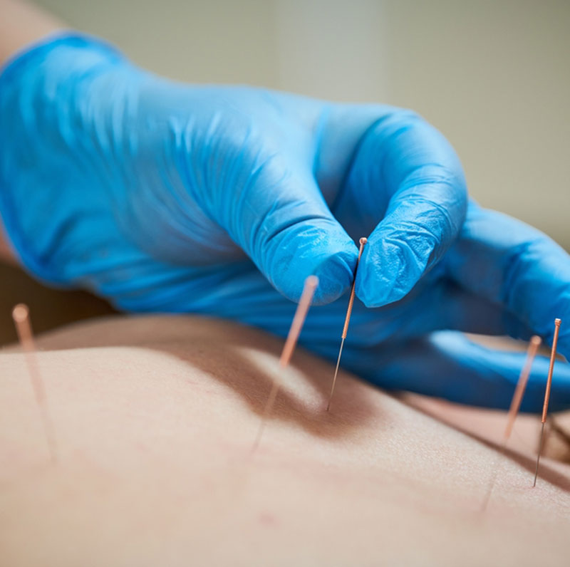 acupuncture services