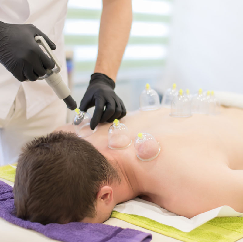 hijama-cupping-therapy-2