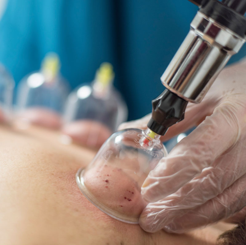 hijama-cupping-therapy-3